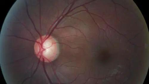 青光眼的克星来袭，助力患者远离视力的“窃贼”